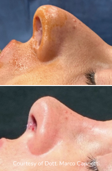 Prima & Dopo Rinoplastica e Rinosettoplastica | Intervento di correzione del naso